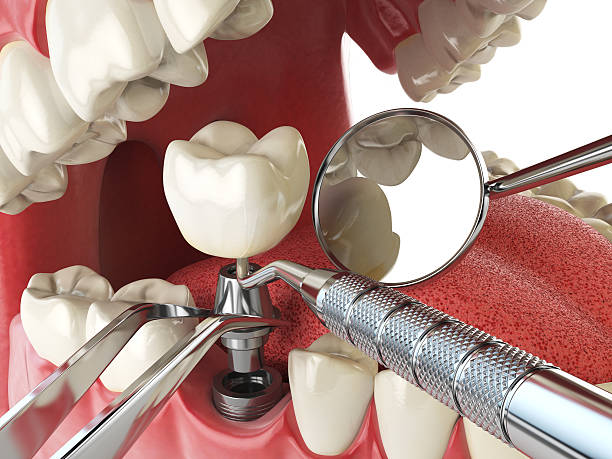 Best Emergency Denture Repair in Ossun, LA
