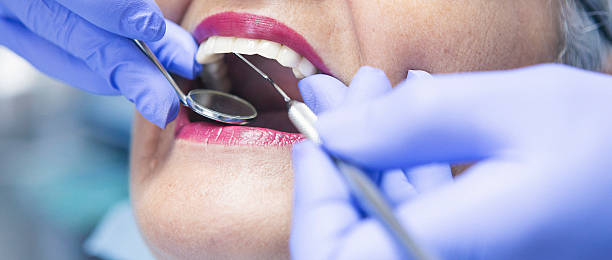 Best Emergency Tooth Extraction in Ossun, LA